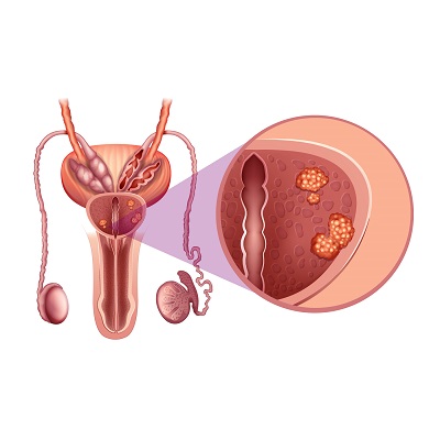 Prostate Cancer